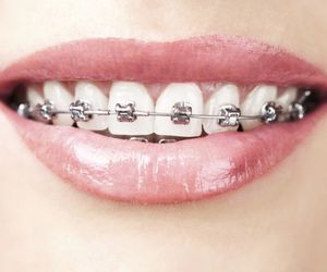 14 pytań o aparaty ortodontyczne