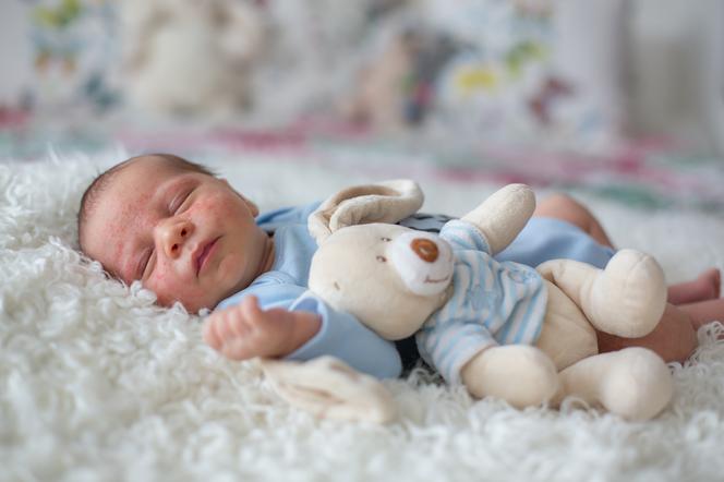 Trądzik niemowlęcy - skąd na twarzy niemowlaka biorą się krostki?