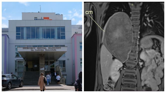Wielki sukces lekarzy z Białegostoku! Usunęli gigantycznego guza z klatki piersiowej dziecka