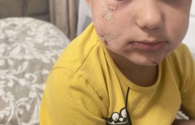 Pogryziony Franek potrzebuje pomocy. Policja szuka właściciela psa. Do szpitala dotarła anonimowa wiadomość