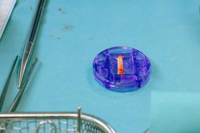 Lubelscy lekarze przeprowadzili pierwszą taką operację w Polsce!