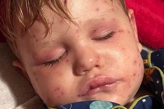 Dramat 2-latka. Wjechał w gniazdo os i został użądlony 150 razy. Teraz walczy o życie