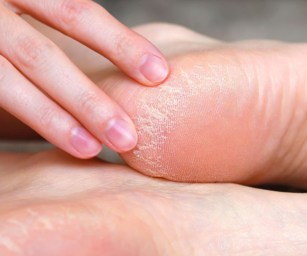 Sposób na suche pięty