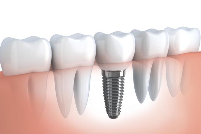 Implanty tytanowe czy cyrkonowe – które implanty zębowe wybrać?