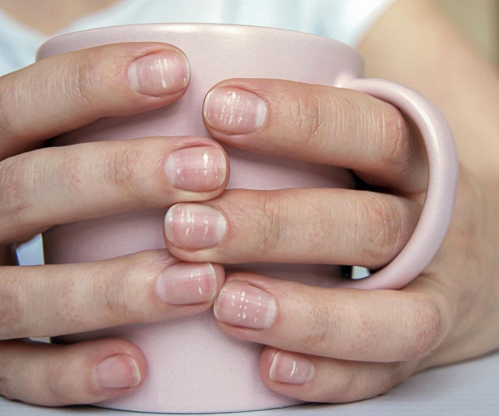 Zmiany na paznokciach, które powinny cię zaniepokoić. Nie lekceważ ich [GALERIA]