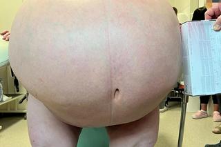 Wycięli pacjentce 100 kg guza