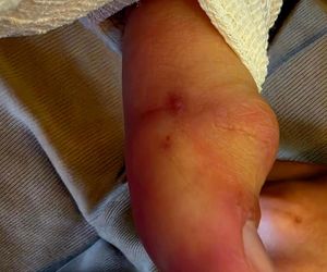 Turysta ukąszony przez żmiję.