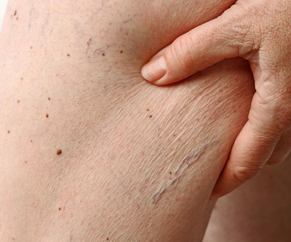 Przez 10 lat mówili jej, że to wysypka. Okazało się, że miała nowotwór