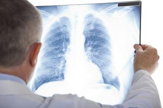Lekarz pokazuje, jak koronawirus niszczy płuca młodych ludzi