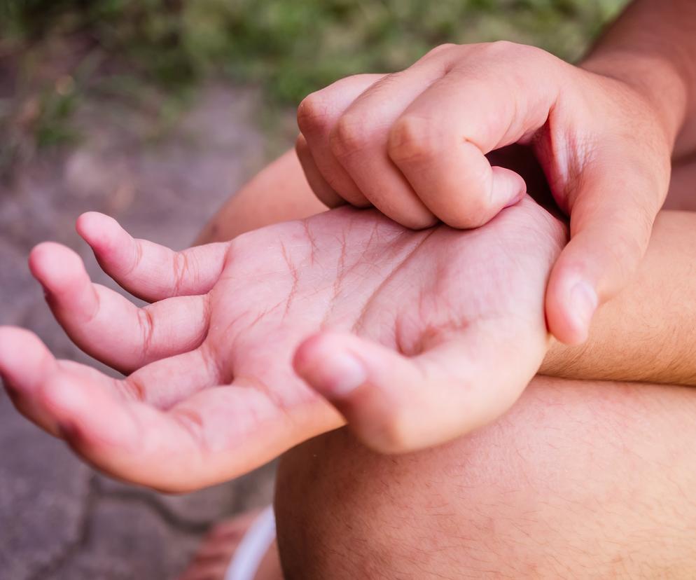 Dziecko i pies z poparzeniami chemicznymi po wizycie w Parku Skaryszewskim. Winna nieznana substancja?