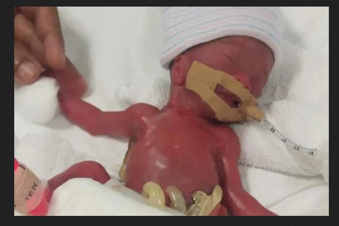 Najmniejsze niemowlę świata wypisane ze szpitala. Maluch urodził się cztery miesiące przed terminem
