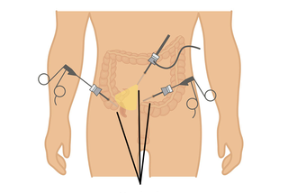 Schemat laparoskopowego usunięcia wyrostka robaczkowego
