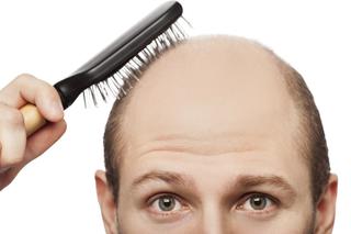 PRZESZCZEP WŁOSÓW: jak przebiega zabieg? Ile kosztuje przeszczep włosów?