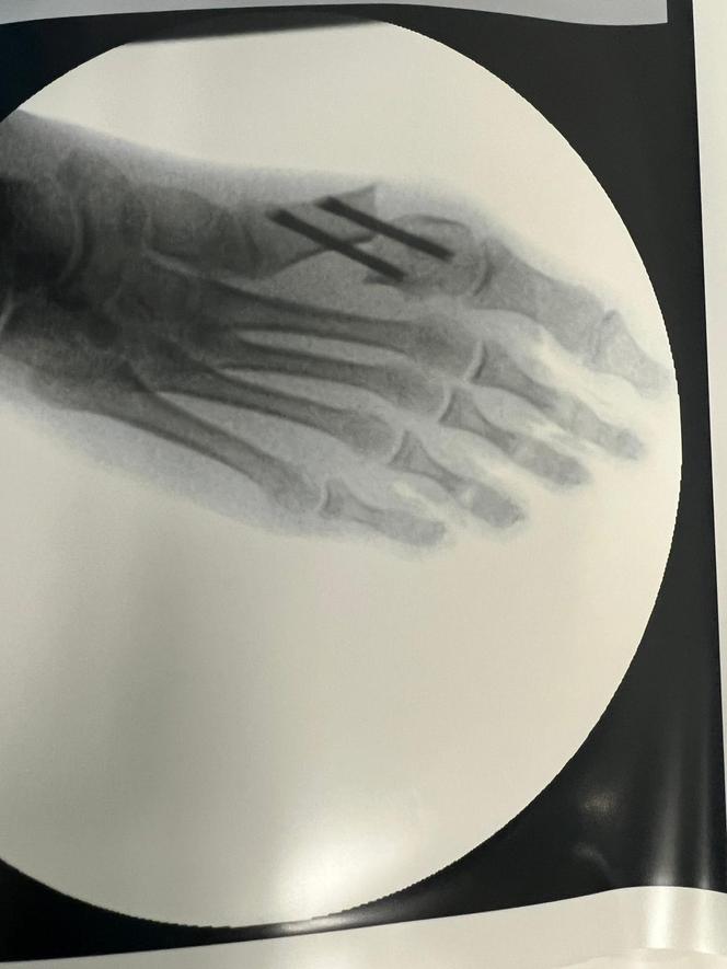 Chorzów. Innowacyjny zabieg u dziecka przeprowadzony po raz pierwszy na Śląsku