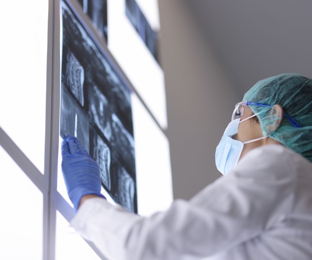 Złamanie kręgosłupa – czy zawsze prowadzi do kalectwa?