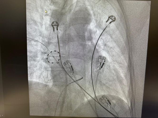 Szpital 4Cardia w Kraśniku zaczął stosować zabiegi nową techniką ablacji