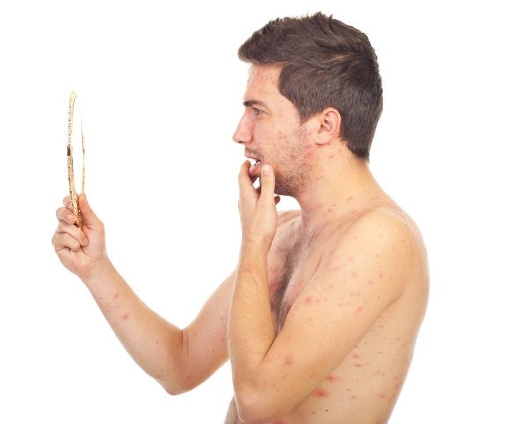 Ospa wietrzna u dorosłych. Objawy i leczenie ospy u dorosłych. Powikłania po ospie wietrznej u dorosłych