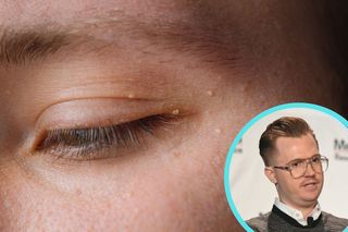 Dermatolog z Polski wykrył najmniejszego raka świata. Krył się w plamce na policzku 
