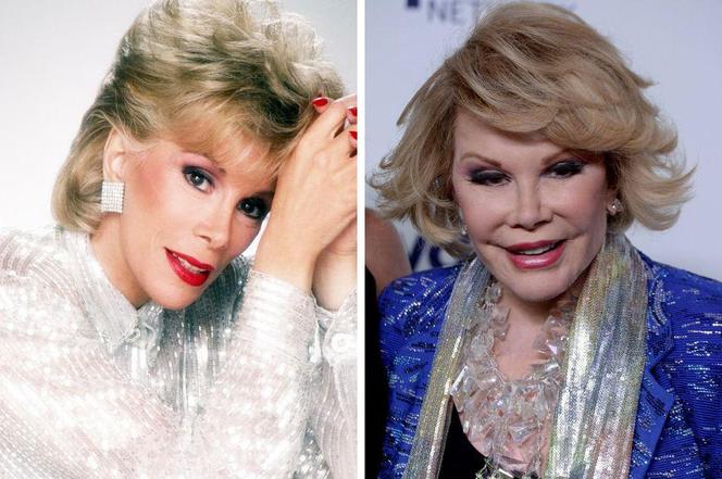 Joan Rivers - PRZED i PO