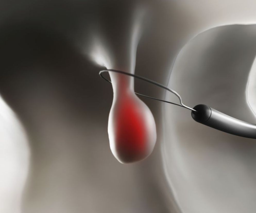 Polipy w nosie  są mniej groźne niż  polipy w krtani.  Jakie są  przyczyny  ich powstawania? Jakie dają  objawy ? Na czym polega ich  leczenie ?