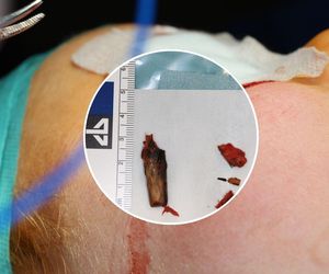 Chłopczyk przez 2 miesiące miał wbity kawałek drewna w policzku. Pomogli katowiccy lekarze