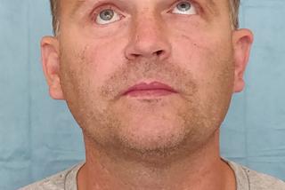 Wydrukowali mu nowe kości twarzy