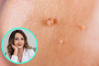 Naklej plasterek i po kłopocie? Dermatolożka ostrzega 