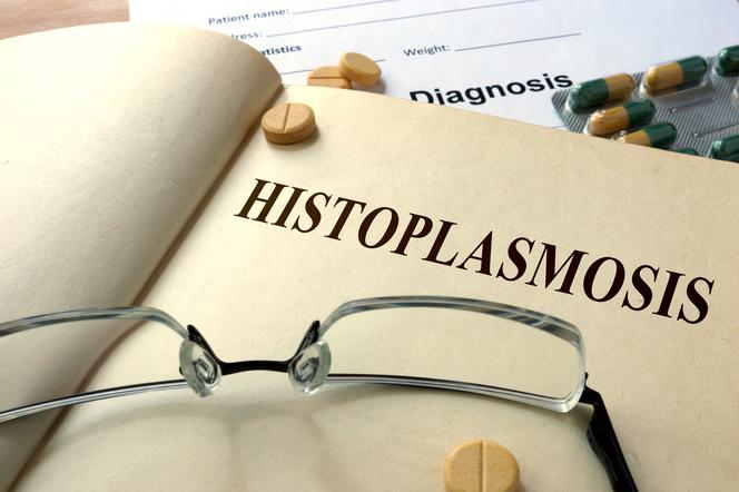 Histoplazmoza (choroba Darlinga): przyczyny, objawy,leczenie