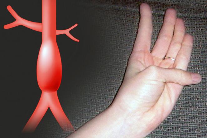 Prosty test przy pomocy  kciuka może wykryć tętniaka aorty. ZOBACZ jak go zrobić!