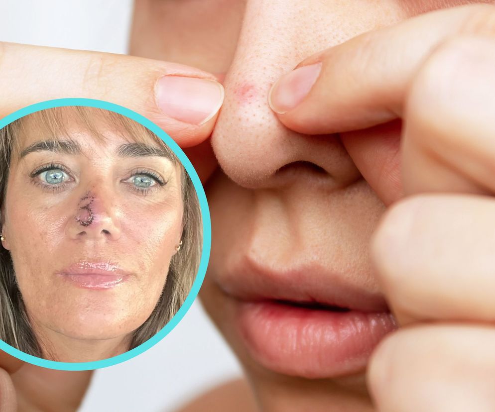 Myślała, że jest za stara na pryszcze. Okazało się, że to rak