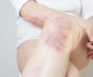 Łuszczycowe zapalenie stawów -  przyczyny, objawy, leczenie 