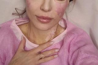 Oblali je twarz kwase. Tak wygląda modelka Katarzyna Dacyszyn po siedmiu latach