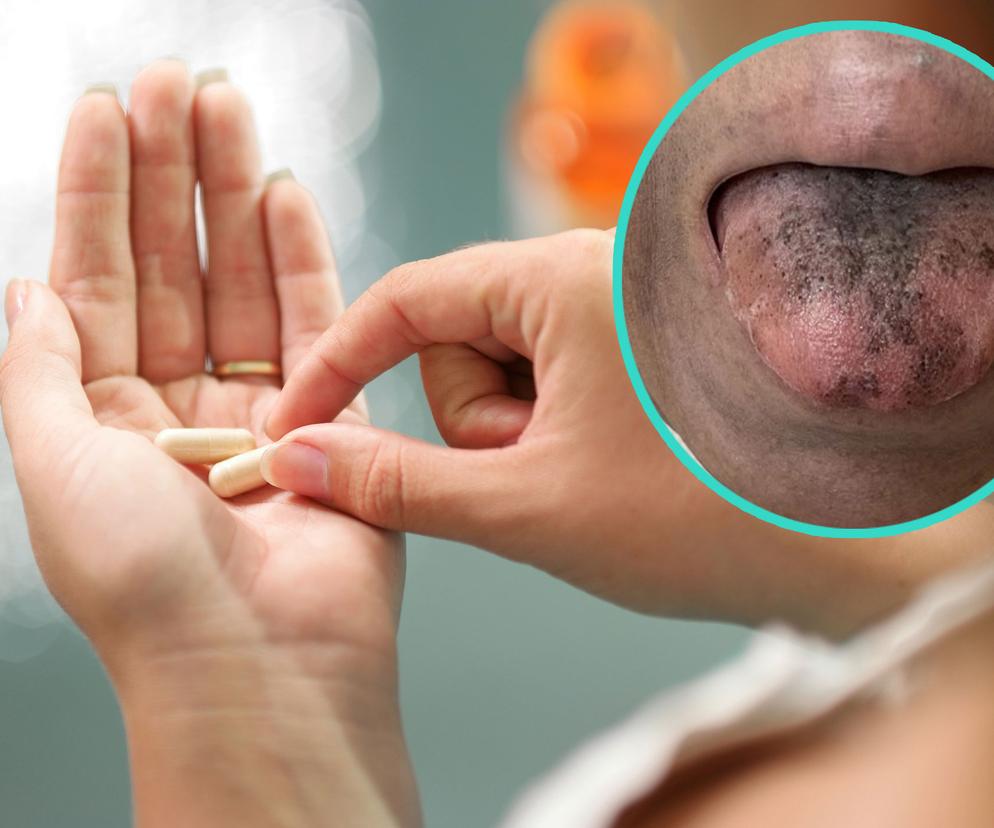 Wzięła popularny antybiotyk. Jej język zrobił się czarny i włochaty