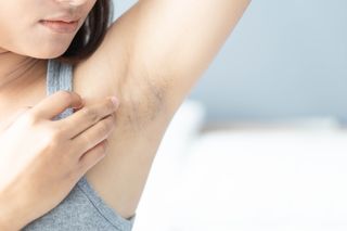 Ciemne plamy pod pachami to letnia zmora kobiet. Te triki pozwolą się z nimi uporać
