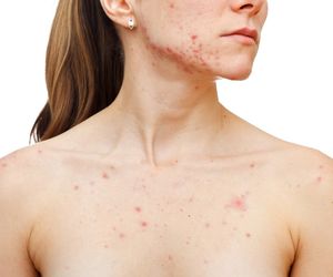 8 sposobów, by wygrać z trądzikiem