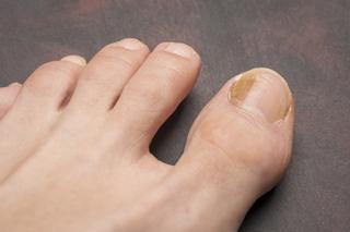 Kolor paznokci zdradzi, jaka choroba rozwija się w ciele. Tak je rozszyfrujesz
