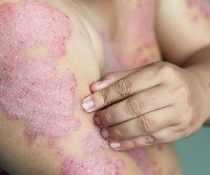 Fotochemioterapia czyli terapia PUVA - wskazania i przebieg