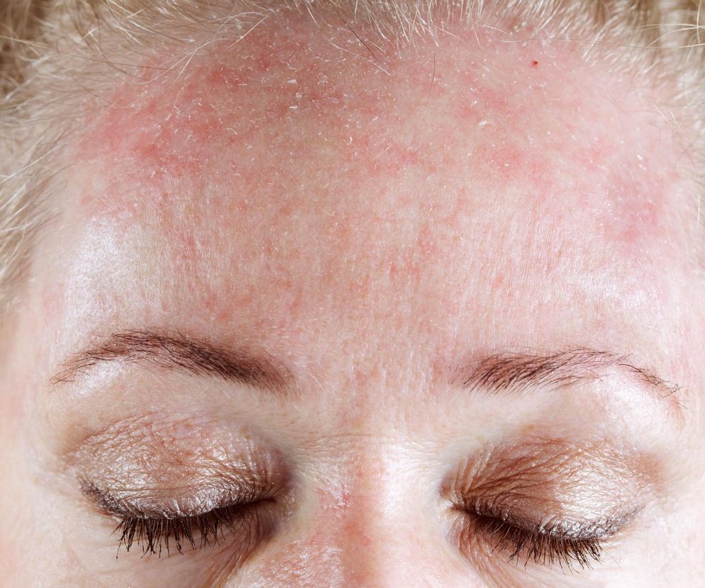 Tak rozpoznasz, że jesz za dużo słodyczy. Czym jest cera cukrowa?