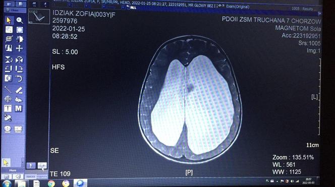 6-letnia Zosia z Tychów potrzebuje pomocy internautów, żeby stanąć na nogi 