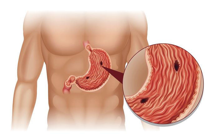 HELICOBACTER PYLORI: bakteria, która może doprowadzić do RAKA
