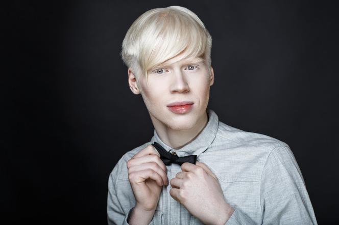 Albinizm (bielactwo wrodzone) - rodzaje, przyczyny, objawy. Czy albinizm można wyleczyć?