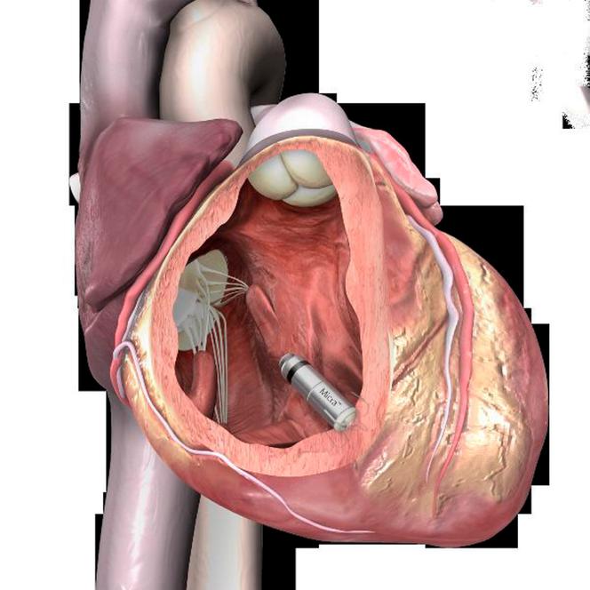 SERCE NA MIKROBATERIĘ
