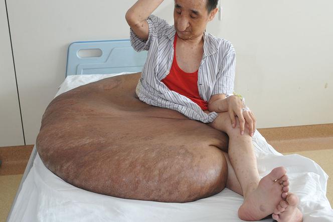 Mężczyzna z gigantycznym guzem! Narośl ważyła 107 kilogramów!