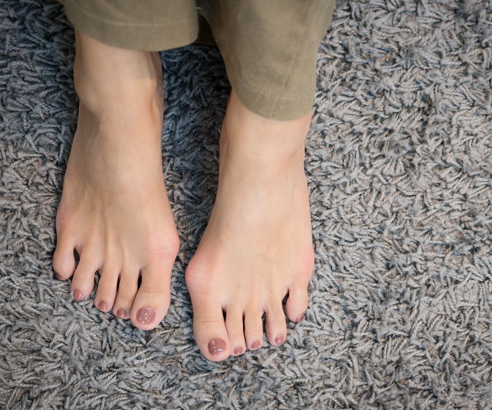 Ćwiczenia korekcyjne na haluksy (paluch koślawy)