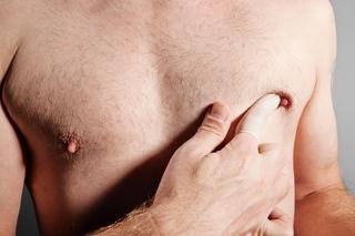Te objawy mogą świadczyć o raku piersi u mężczyzn. Nie wolno ich ignorować