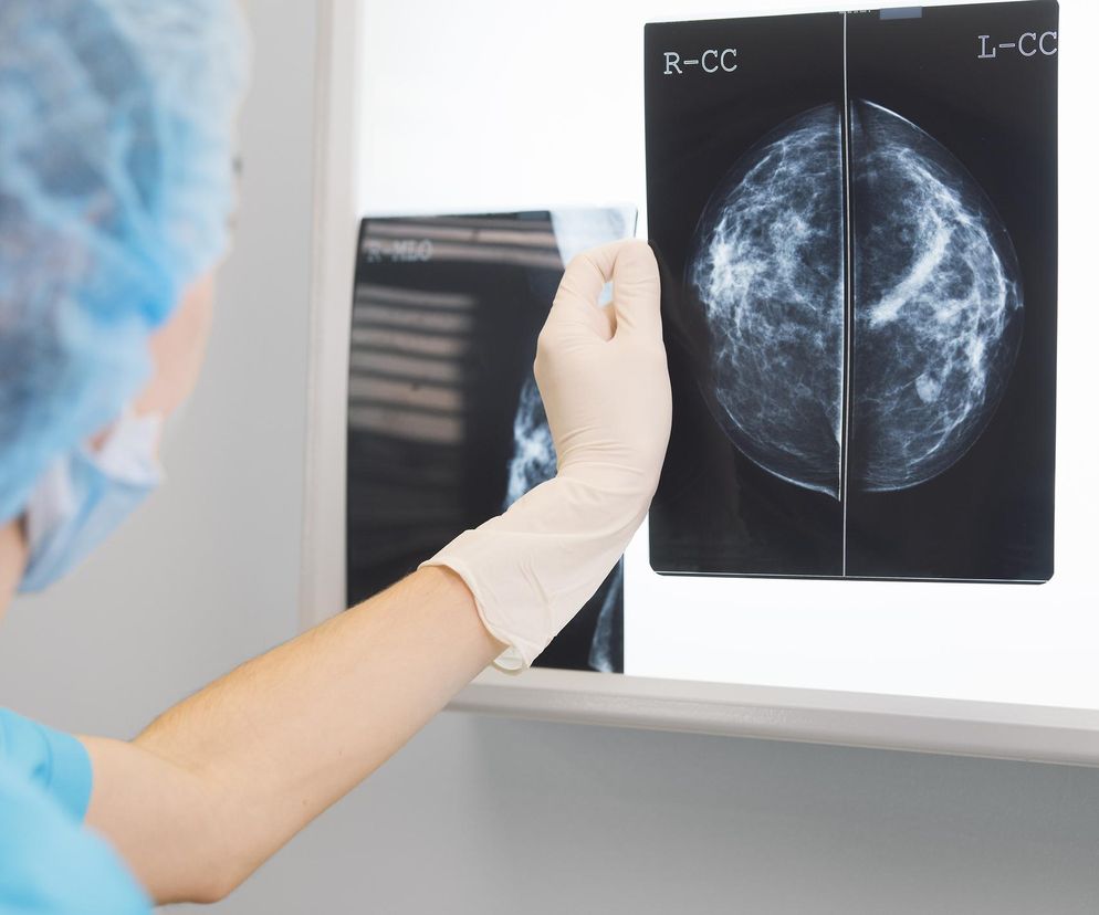 Lekarz w czepku i masce, ubrany w niebieski strój medyczny i lateksową rękawiczkę, analizuje kliszę mammograficzną ukazującą przekroje piersi (R-CC, L-CC) pod kątem zmian nowotworowych. Na portalu Poradnik Zdrowie znajdziesz więcej informacji o raku piersi.
