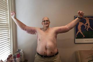 Najgrubszy człowiek świata schudł 300 kilogramów 