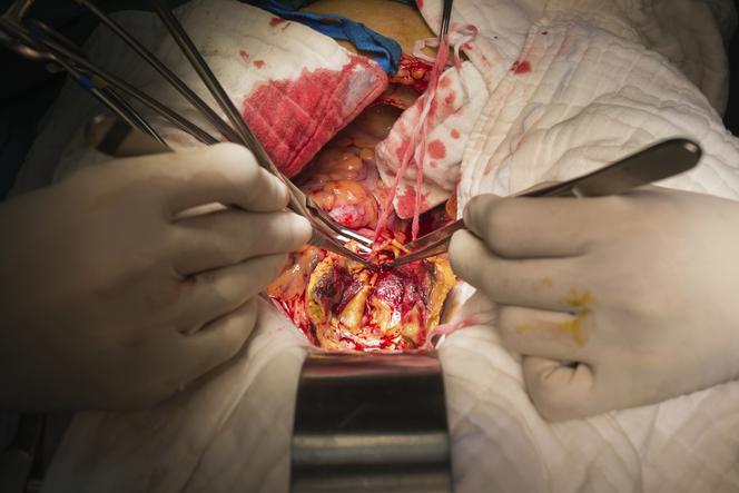 Tętniak aorty brzusznej - przyczyny, objawy i leczenie