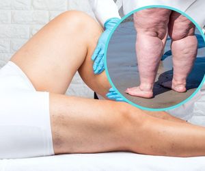 Lipoedema – mało znany duży problem. Czym jest „choroba grubych nóg”