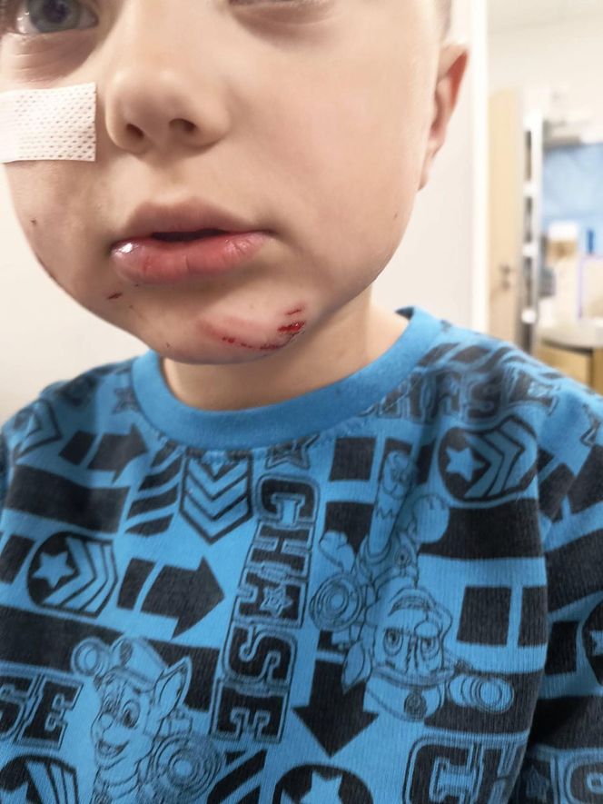 Pies pogryzł 4-letniego Frania. Chłopczyk w szpitalu, policja szuka właściciela